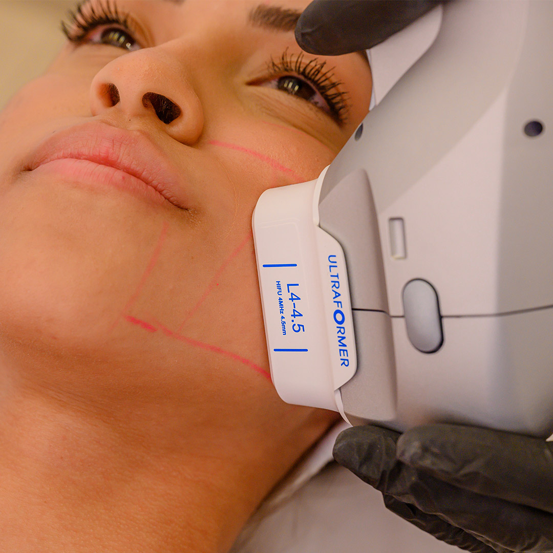 Ultraformer Fullface Bio renew Clinica de Estetica 1 - Clinica Pellier Brasilia