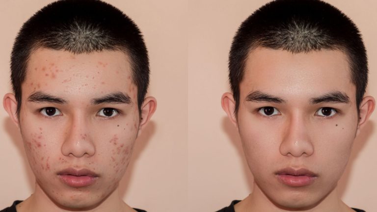 Antes de tudo, muitas pessoas reconhecem o Roacutan®, nome comercial da isotretinoína, como um dos tratamentos mais eficazes para acne severa e resistente. Por isso, muitos passaram a chamá-lo de “pílula da beleza”, já que os resultados na pele impressionam. Ainda assim, apesar dos benefícios, o uso do Roacutan® exige acompanhamento médico constante, justamente pelos riscos envolvidos.