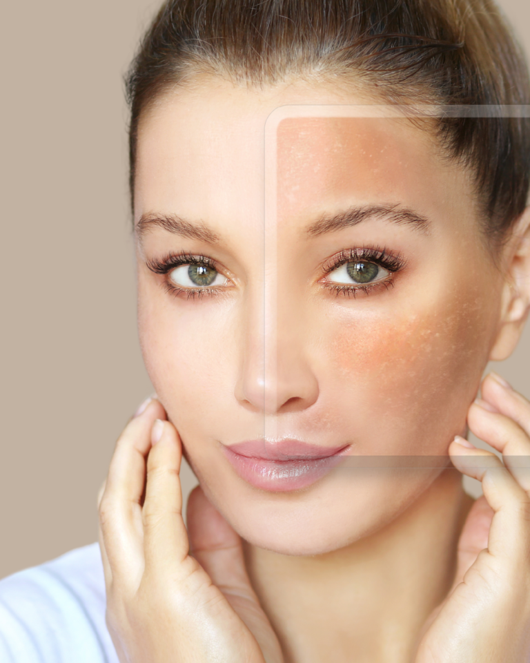 MELASMA BRASILIA