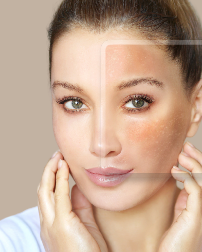 MELASMA BRASILIA